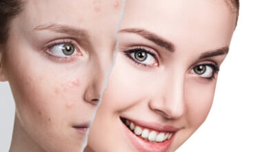 Clear Skin Quickly with Accutane: The Ultimate Acne Fighter