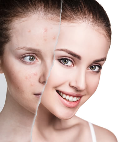Clear Skin Quickly with Accutane: The Ultimate Acne Fighter
