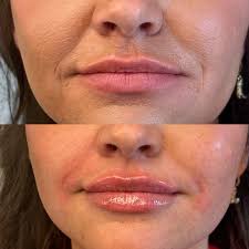 Lippeninjektionen